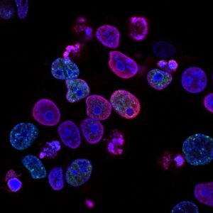 obesidad como factor de riesgo de hasta 13 tipos de cáncer