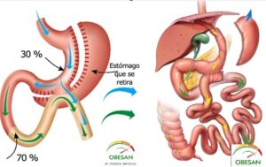 bipartición intestinal nueva técnica cirugía obesidad